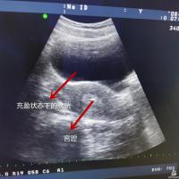 胚胎移植为什么要憋尿，超声下引导移植有哪些优势？